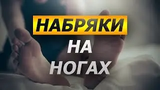 Набряки на ногах. Чи завжди причиною набряків ніг є варикоз?