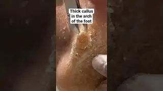 Thick Callus In The Arch of the Foot