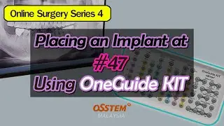 Placing Implants at #47 Using OneGuide KIT