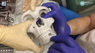 Fracture of the lower jaw. Resection of the body of the mandible, tooth extraction 3.8, 4.8.