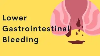 Quick overview on managing a Lower Gastrointestinal Bleeding (Lower GI Bleeding)