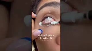 Blephex Procedure Video
