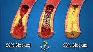 Is 70% Blockage Fatal?
