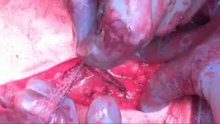 Mesh Sutured Repair Tying Technique