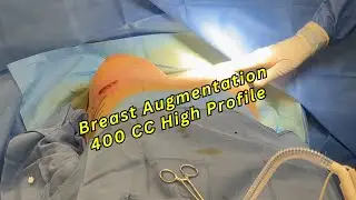 Breast Augmentation with 400 CC Mentor High Profile Implants