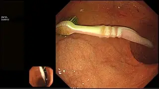 EXTRACTION OF TOOTHBRUSH FROM STOMACH