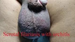 Bilateral orchidectomy