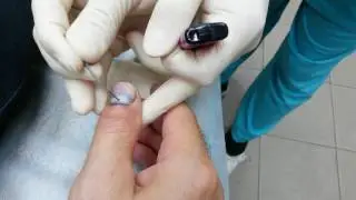 Лечение гематомы под ногтем