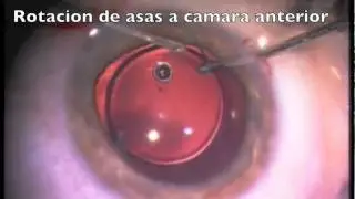 E4 LIO insertado ruptura.m4v