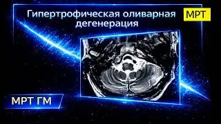 Гипертрофическая оливарная дегенерация на МРТ