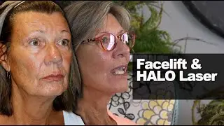 Facelift & HALO Laser - Age 65-70 - Dr. Scott Holley