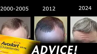 20 Year Dutasteride Veteran's Advice: Start EARLY.