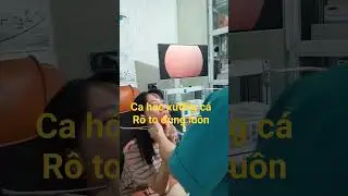 Hóc xương cá rô phi to đùng luôn||  BS Nam Hưng Yên