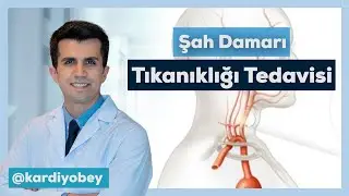 Şah Damarı Tıkanıklığı Nasıl Açılır?