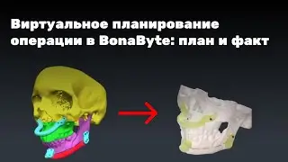 Виртуальное планирование операции в BonaByte: план и факт