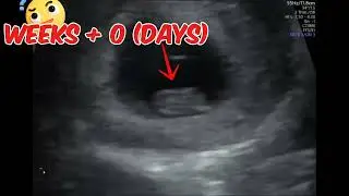How 8 weeks, 0 days  baby  look like on  real time ultrasound # ultrasound #8 weeks