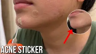 How long for an acne sticker to work?