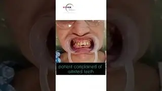 Smile Makeover in 7 days for Teeth Attrition #teeth #smilemakeover #smile