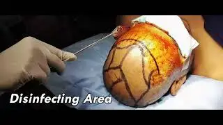 Do you also suffering from baldness? here the solution. Hair Growth, Hair Transplant in Surat.