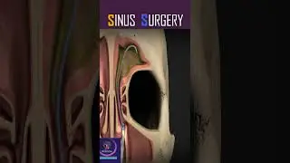 Ballon Sinuplasty, Sinus Surgery 