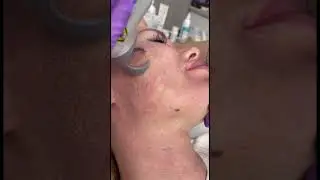 Лазерная шлифовка #клиникамосква