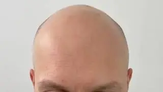 The Best before & after Scalp Micropigmentation Treatment & Training