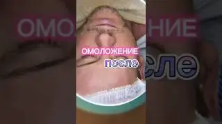 ОМОЛОЖЕНИЕ ЛИЦА ПОСЛЕ