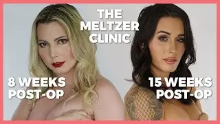 Trans Women React to Each Other's Boobs (Post-Op) The Meltzer Clinic | Casey Blake