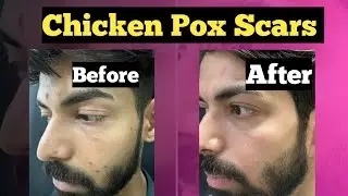 Chicken pox scar treatment with laser / 9999 747 717