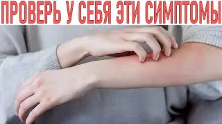 ПРОВЕРЬ ЭТО У СЕБЯ | 2 признака на вашей коже которые указывают на рак печени