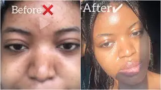 HOW TO GET RID OF DARK CIRCLES PERMANENTLY!! 👀 ( Fast and Effective)