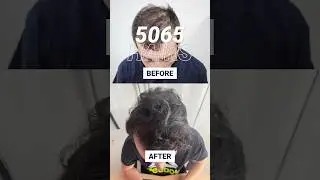 Crown area restored ✔️FUE hair transplant with 5000+ hairs #shorts #hairpalace