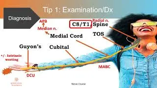 10 TIPS in dealing with Cubital Tunnel Syndrome