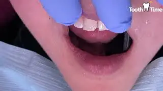 Dental Bonding after Braces - Treatment option - Tooth Time Family Dentistry New Braunfels