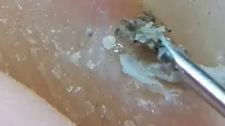 How to clean in depth lateral toenail fold #7 (After beach)