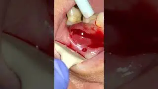 TOOTH ABSCESS #phonk #beats #toothless #swelll #abscess