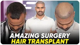 Hair Transplant in Dewas | Best Results & Cost of Hair Transplant in Dewas
