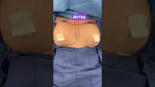 Breast Augmentation - Before and Immediate After! # 