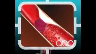 Ischemic Stroke