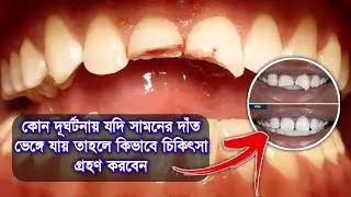 দূর্ঘটনায় আঘাত পাওয়া দাত কিভাবে স্বাভাবিক সুন্দর করবেন@DentalHealthTips