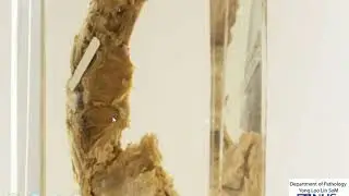 Oesophagus: Carcinoma