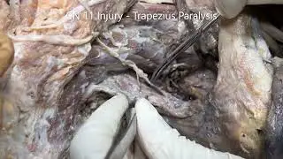 CERVICAL and BRACHIAL PLEXUS ACCESSORY Nerve SUBCLAVIAN Artery with Clinical Aspects – Sanjoy Sanyal