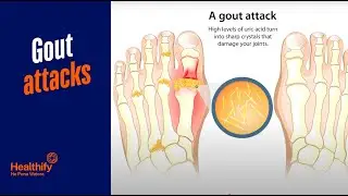 06 Gout attacks
