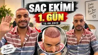 Saç Ekimi yaptırdım 1. Gün (12.06.2023)  #hairtransplant