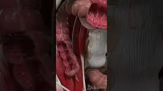 🔬 Inside the Colon: Exploring the Inner Lining 🔬  
