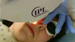 Удаление сосудов на лице и теле лазером IPL Quantum