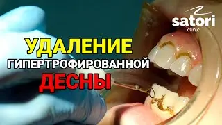 REMOVAL OF HYPERTROPHIZED GUM
