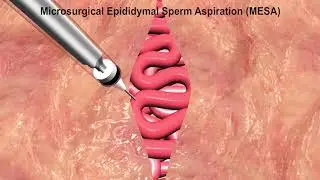 ARC Fertility Hospital || PESA MESA || Advanced Laparoscopy and Hysteroscopy Centres