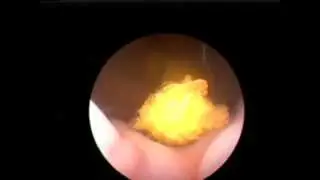 Minimally Invasive Canine Calcium Oxalate Bladder Stone Removal - Cystoscopy