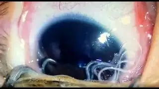 Doctors pluck ELEVEN live worms from baby's eye